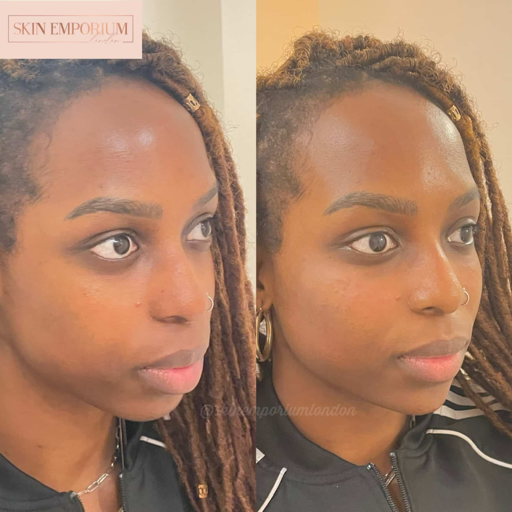 Before and after photo of a women having received lip filler treatment at the Skin Emporium in Clapham, London.