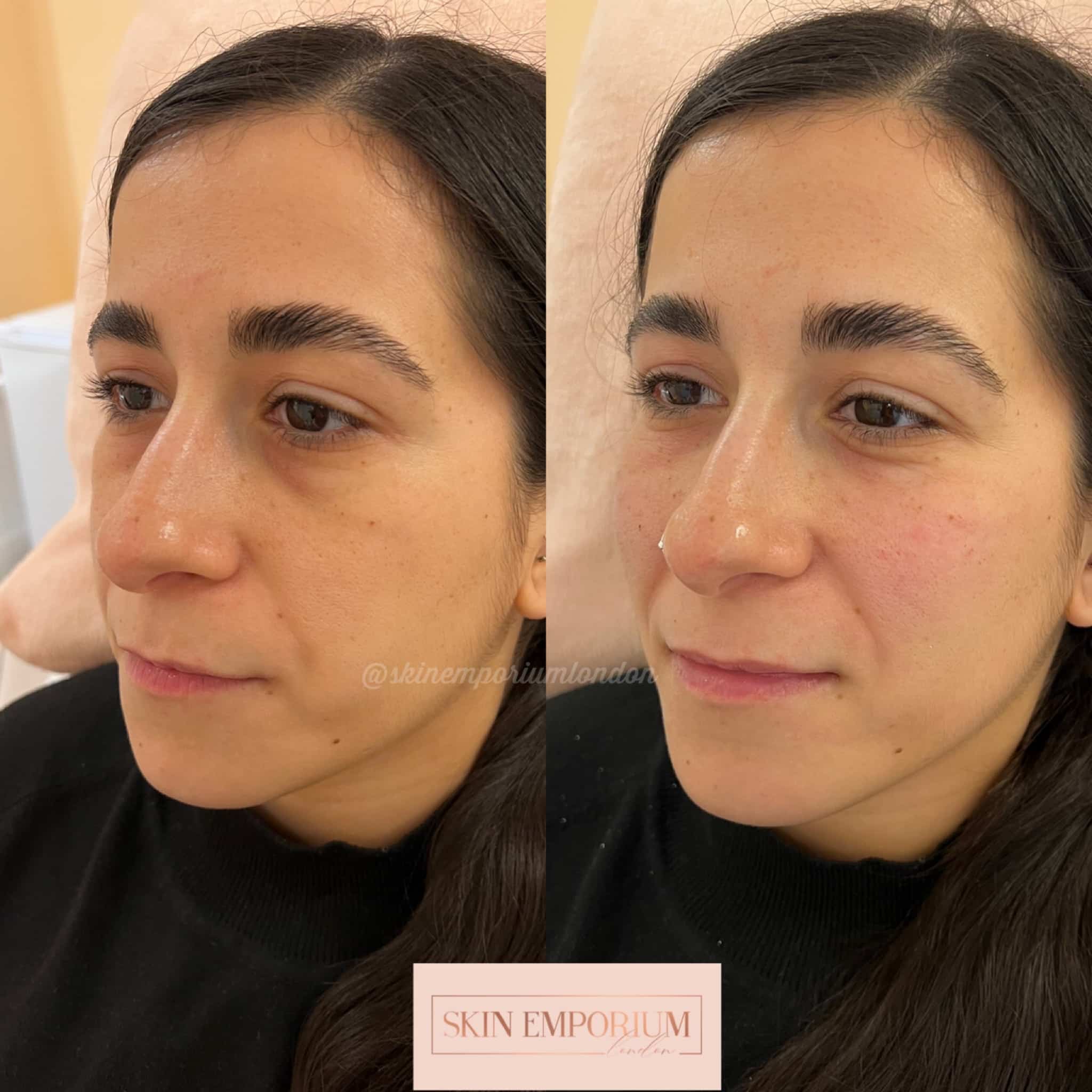 Before and after photo of a women having received cheek filler treatment at the Skin Emporium in Clapham, London.