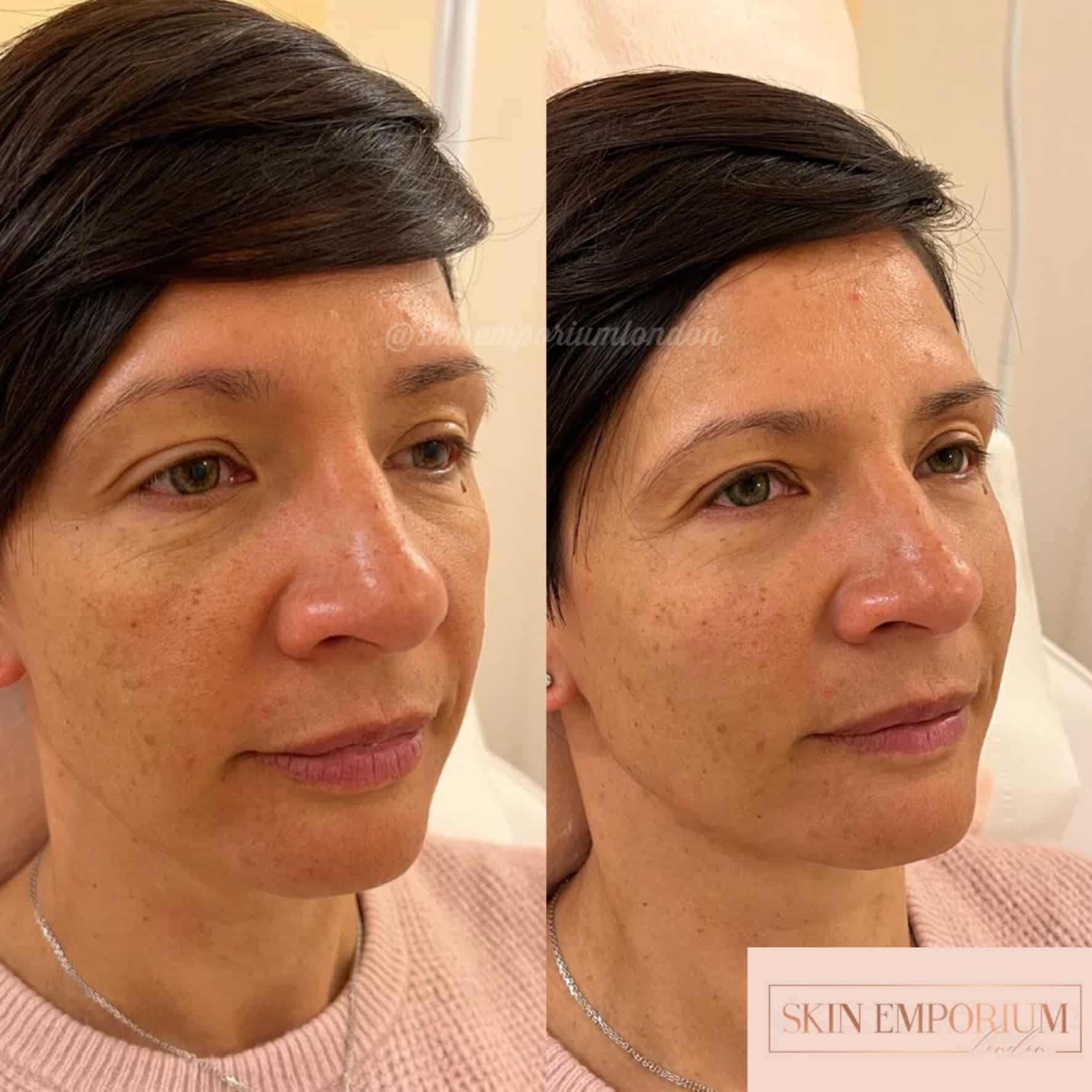 Before and after photo of a women having received facial filler treatment at the Skin Emporium in Clapham, London.