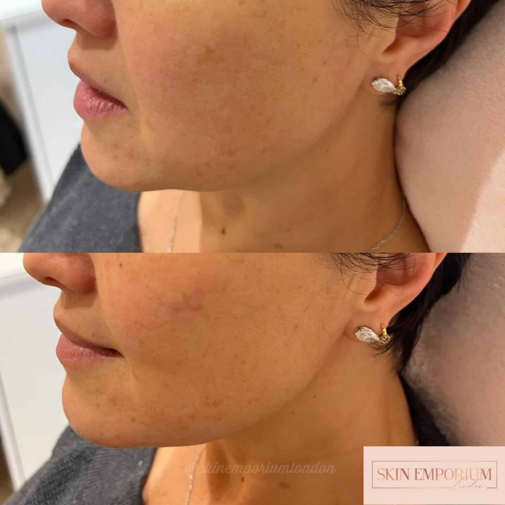 Before and after photo of a women having receivedcheek dermal fillers at the Skin Emporium in Clapham, London.