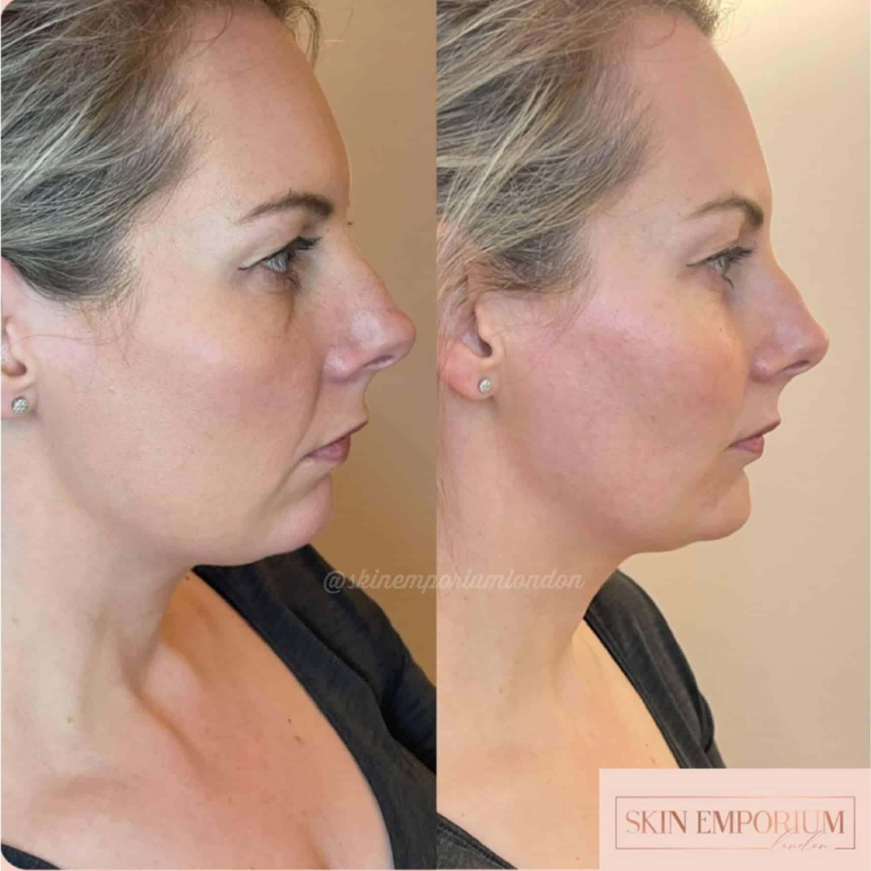 Before and after photo of a women having received dermal filler treatment at the Skin Emporium in Clapham, London.