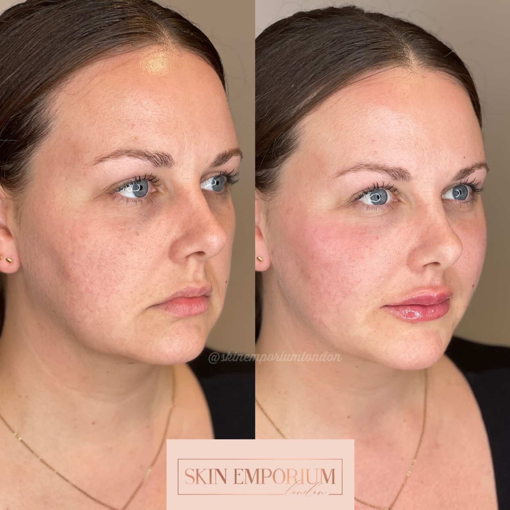 efore and after photo of a women having received lip fillers at the Skin Emporium in Clapham, London.