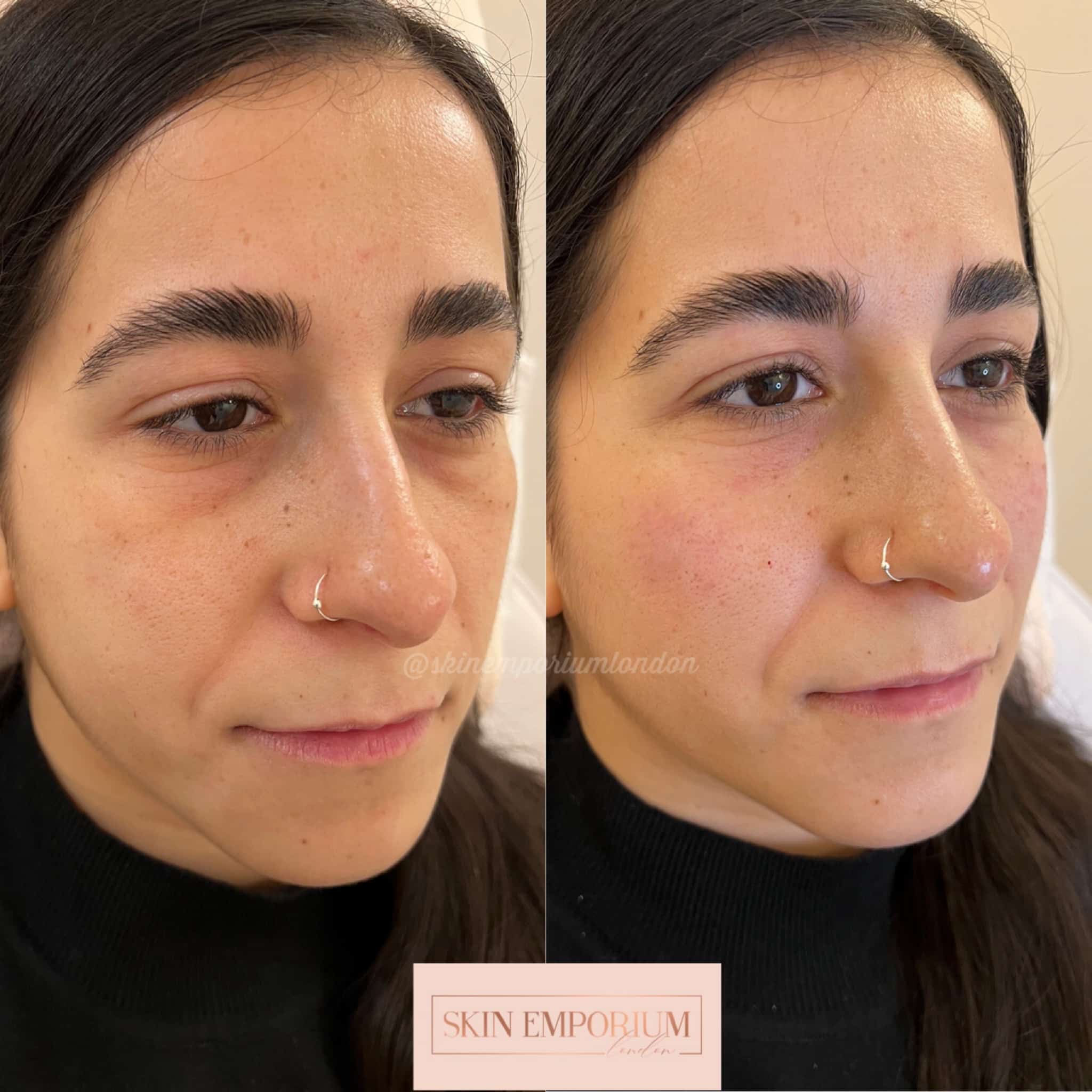 Before and after photo of a women having received chin dermsl fillers at the Skin Emporium in Clapham, London.