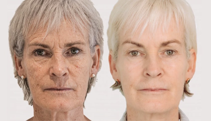 Judy Murray before and after photo showing the results of Morpheus8 non-surgical skin rejuvenation at the Skin Emporium clinic in Clapham, London.